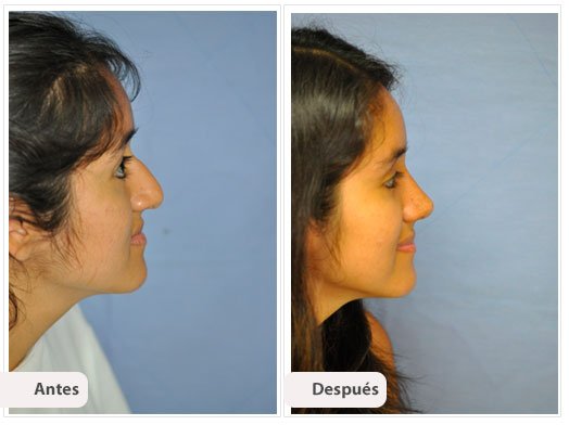 Desviación del Septum Nasal: Perfil Caso 6