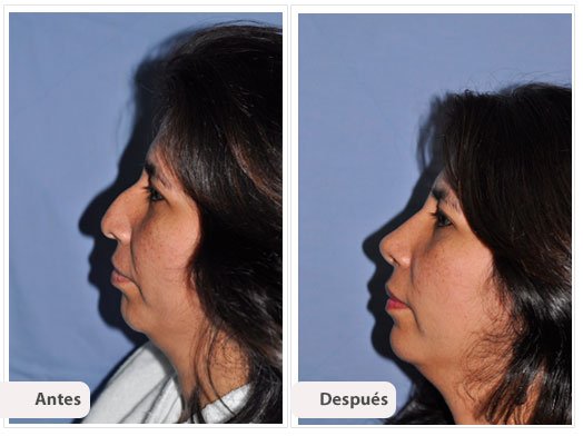 Desviación del Septum Nasal: Perfil Caso 7