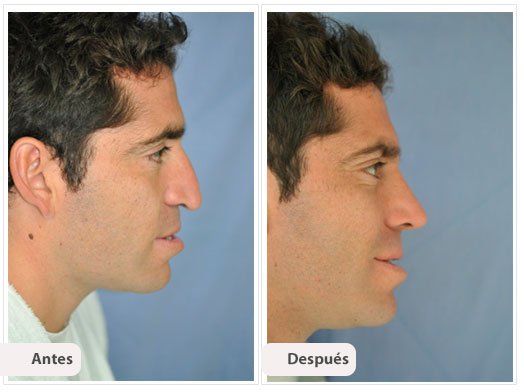 Desviación del Septum Nasal: Perfil Caso 8