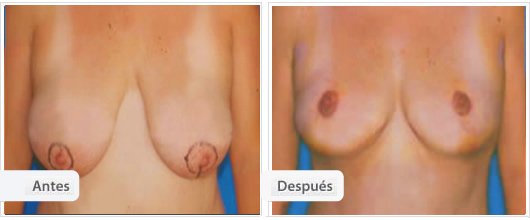 Mamoplastía sin Cicatriz Vertical: Caso 1
